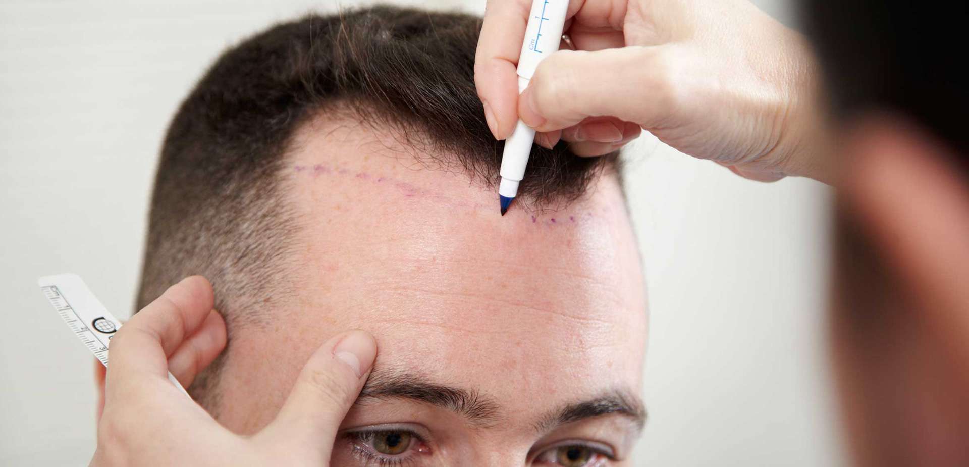 Do I Need Follow-Up Visits After Hair Transplant Surgery?