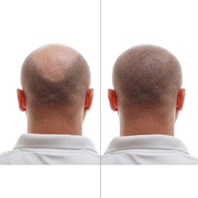 Is Hair Transplant the Best Solution For Hair Loss?