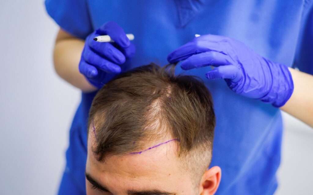 Doctor performing hair transplant for hairline restoration