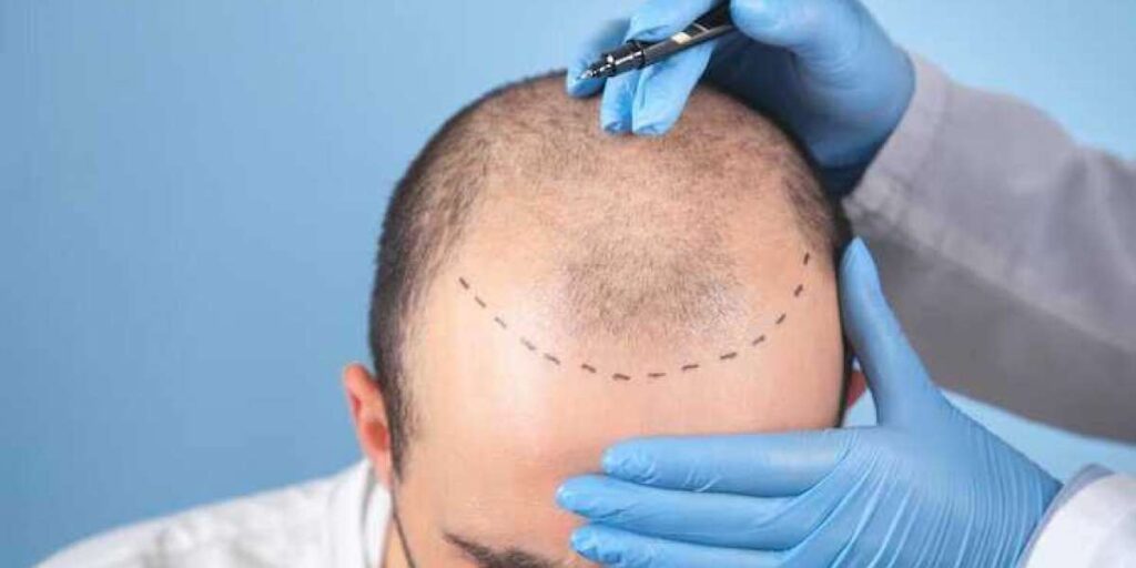 Hair transplant treatment for baldness and hair loss solution