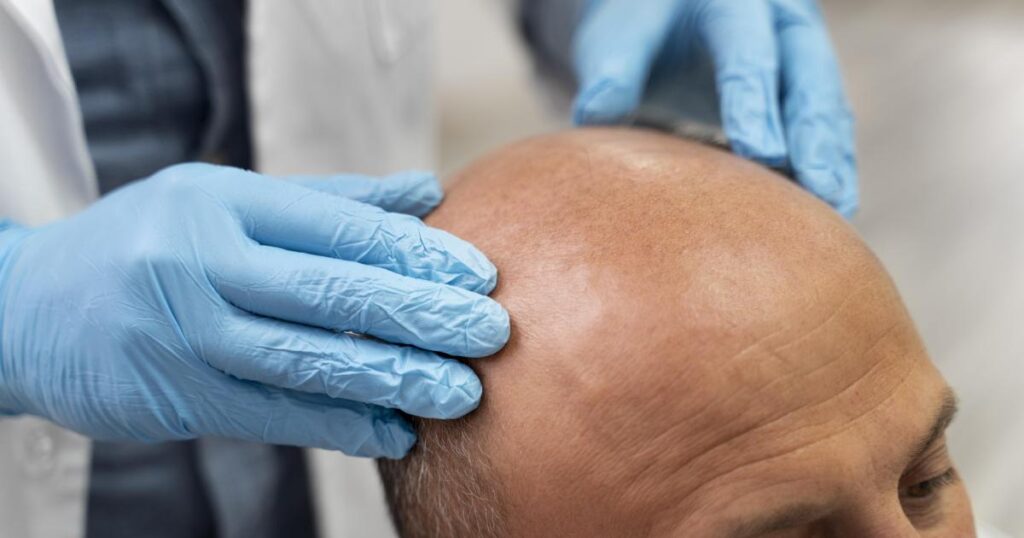 Hair transplant results showing natural-looking hair growth and improved density, highlighting factors that affect different outcomes after surgery.