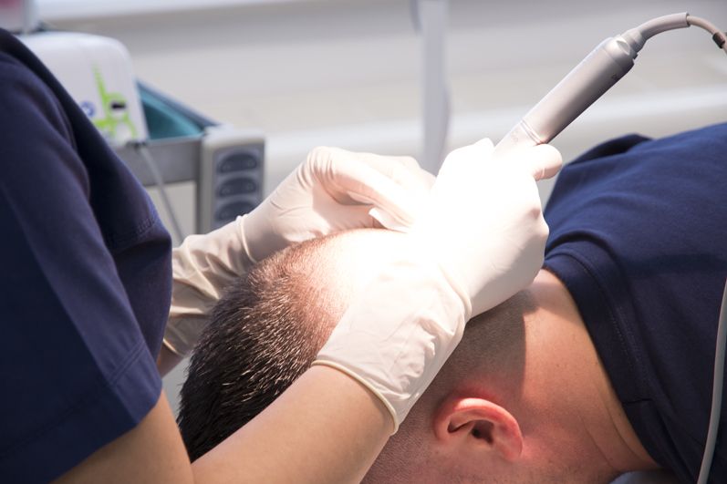 Donor hair importance in hair transplant showing healthy follicles used for natural hair restoration and improved hair growth results.