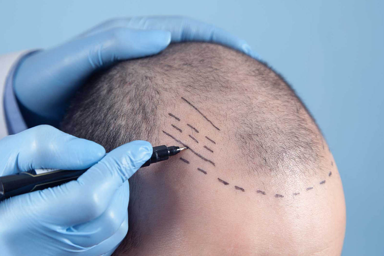 Hair Transplant: Why New Hair Keeps Growing