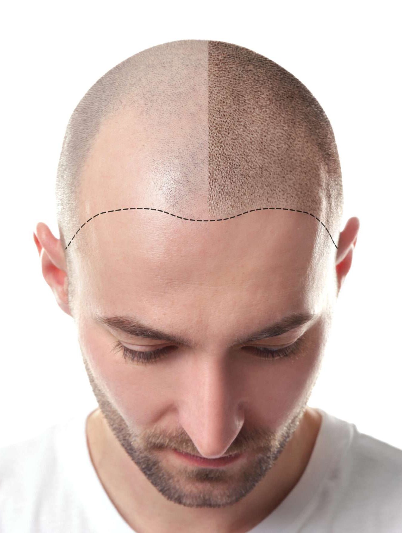 Man before and after hair loss treatment on white background
